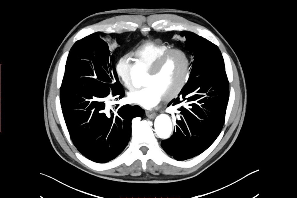 Coronary-CT-Angiography-1.jpg